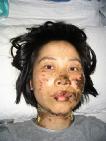 高蓉蓉二零零四年五月七日被酷刑折磨，臉上是電燒灼傷。照片是受傷十天後拍攝的。
