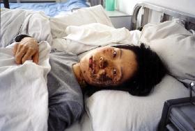 高蓉蓉2004年5月7日被酷刑折磨，臉上是電燒灼傷。照片是受傷10天後拍攝的。