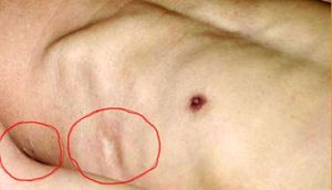 '照片：邵承洛被搗刮肋骨後遺留下的傷疤'