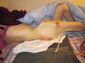 '袁永文被迫害的瘦骨嶙峋'